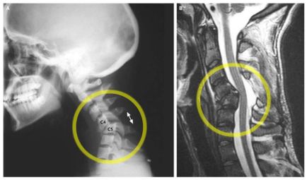 spinal-dislocation-xxl